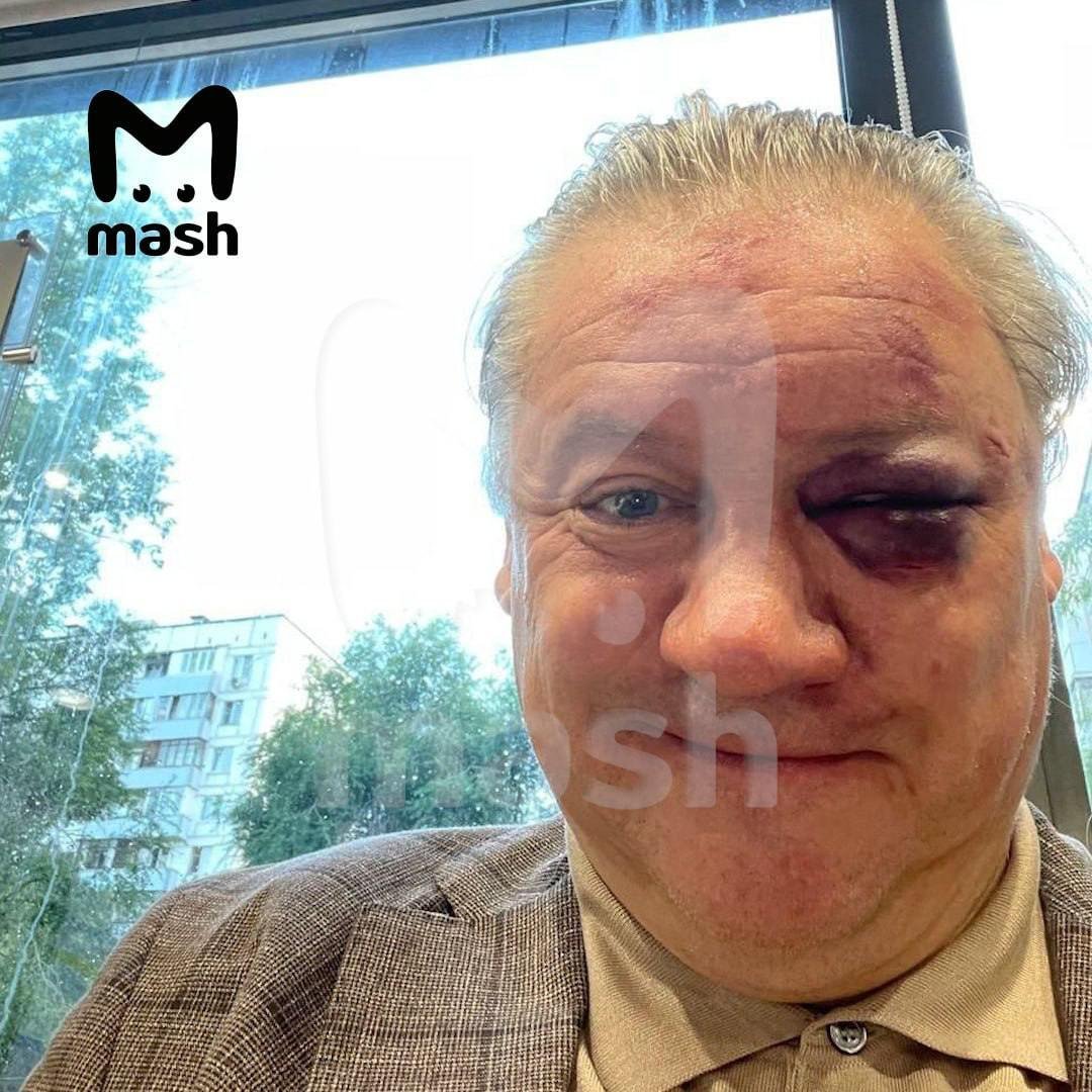 Андрею Канчельскису поставили синяк под глазом в московском баре после просмотра финала Евро (фото)